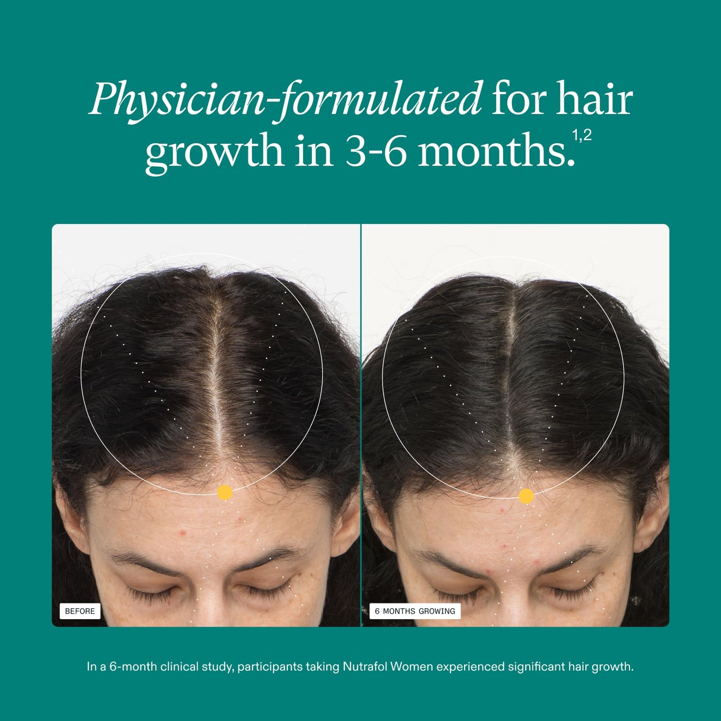 Nutrafol Women's Hair Growth Supplements, for Women Ages 18-44, Clinically Proven Hair Supplement for Visibly Thicker and Stronger Hair, Dermatologist Recommended - 1 Month Supply, 1 Refill Pouch